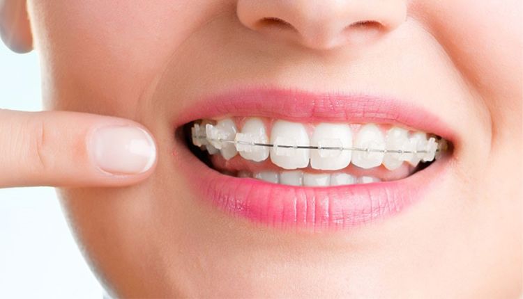 Eating with Braces: Friendly Foods for a Healthy Smile